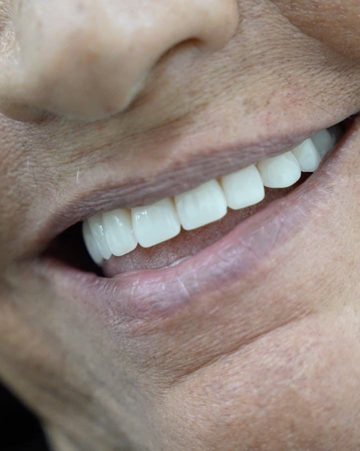 Close de um sorriso com dentes claros e alinhados